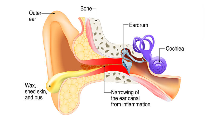 Otitis